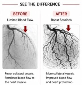 How does ECP/EECP® therapy help angina?
